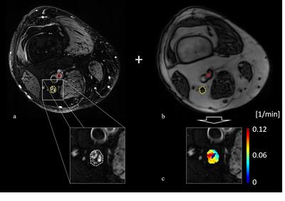 Troponin T Is Negatively Associated With 3 Tesla Magnetic Resonance Peripheral Nerve Perfusion in Type 2 Diabetes